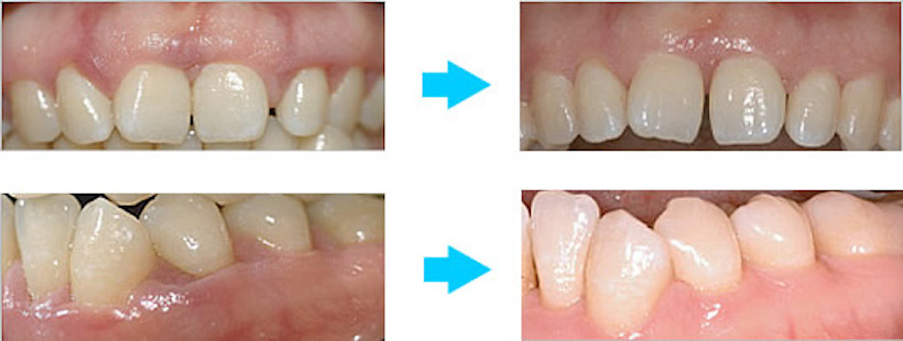 歯周病のレーザー治療の症例